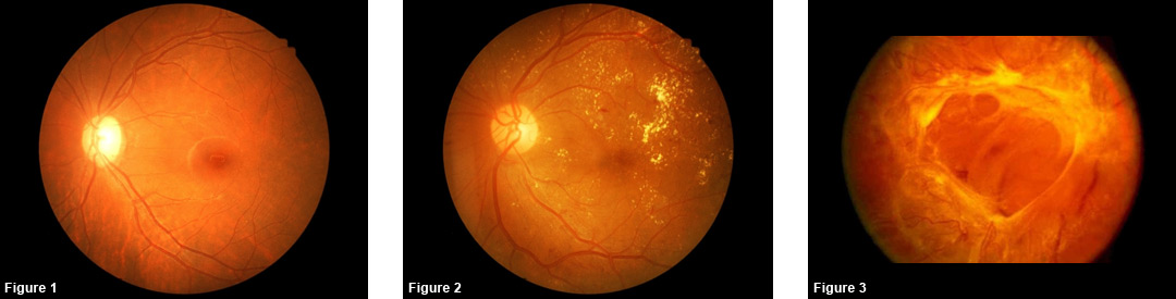 Examples of damage caused to the eye by Diabetic Retinopathy