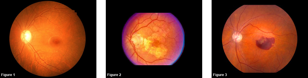 Age Related Macular Degeneration Figures 1-3