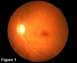 Retina Detachment - Figure 1